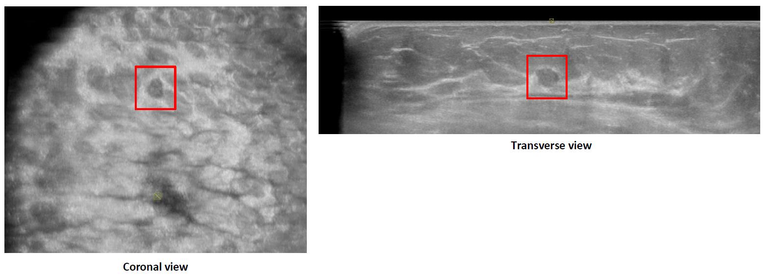 Coronal and transverse automated breast ultrasound views with a lesion marked by a red box.